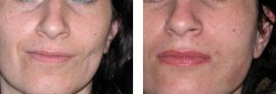 lipofilling
