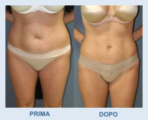lipoaspirazione liposcultura