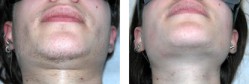epilazione con IPL