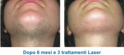 epilazione laser