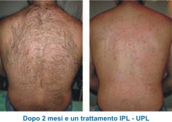 epilazione laser