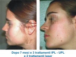 epilazione laser