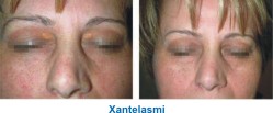 ringiovanimento ablativo skin resurfacing