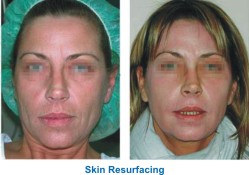 ringiovanimento ablativo skin resurfacing