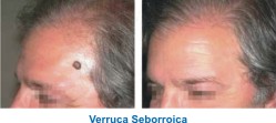 ringiovanimento ablativo skin resurfacing